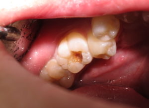 内部の拡大した虫歯