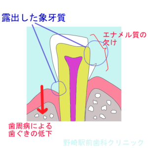 象牙質の欠損した歯牙