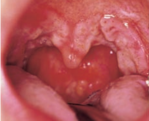 梅毒の口腔内症状