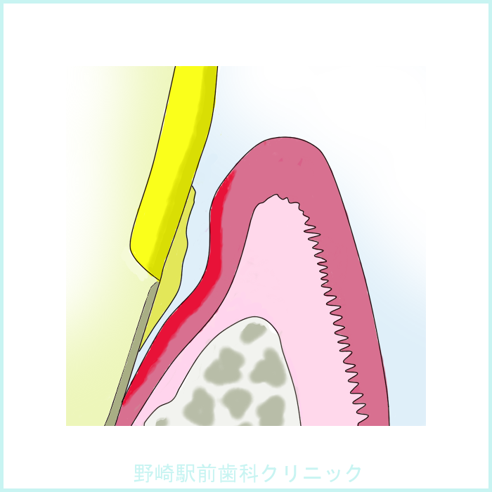 歯周病期
