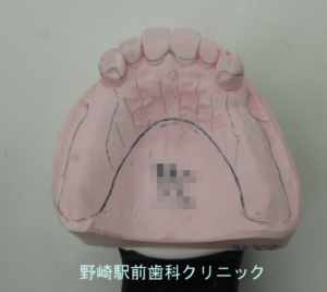 上顎の残存歯