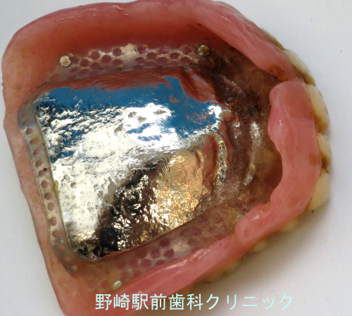 汚れの目立つ金属総義歯