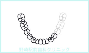 下顎の残存歯式