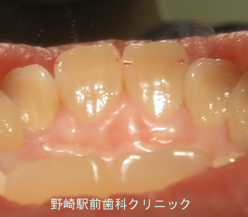 酸蝕歯